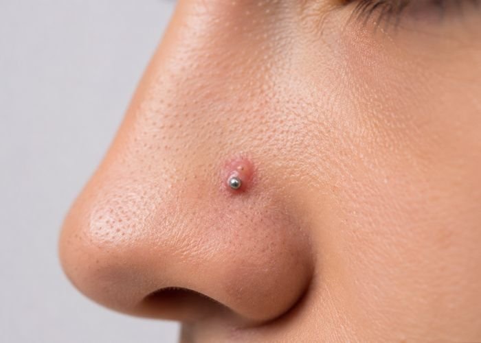 Small irritation bump forming near a healing nose piercing.
